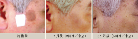 経過画像：使用前,1回使用,4回使用
